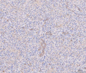 Immunohistochemical staining of FFPE human glioma tissue with ANG2 antibody, HRP-secondary and DAB substrate. HIER: boil tissue sections in pH8 EDTA for 20 min and allow to cool before testing.