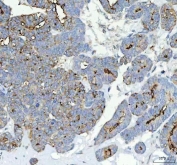 Alkaline Phosphatase / ALPL Antibody Parotid Acinar Cell Carcinoma IHC. Immunohistochemistry staining of FFPE human parotid acinar cell carcinoma tissue with Alkaline Phosphatase / ALPL antibody. HIER: boil tissue sections in pH8 EDTA for 20 min and allow to cool before testing.