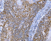 CD44 Antibody Laryngeal Squamous Cell Carcinoma IHC. Immunohistochemistry analysis of CD44 / CD44 antigen expression in FFPE human laryngeal squamous cell carcinoma tissue using antibody. Strong membranous HRP-DAB brown staining is observed in malignant squamous epithelial cells, outlining cell borders and highlighting cell surface localization consistent with CD44 expression. The staining pattern demonstrates cohesive tumor architecture and supports its use for evaluating epithelial organization and CD44-associated cell adhesion in squamous cell carcinoma. Heat induced epitope retrieval was performed by boiling tissue sections in pH 8 EDTA for 20 min followed by cooling before testing.