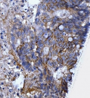CD44 Antibody Rectal Cancer IHC. Immunohistochemistry analysis of CD44 / CD44 antigen expression in FFPE human rectal cancer tissue using antibody. Membranous HRP-DAB brown staining is observed in tumor epithelial cells, outlining cell borders and highlighting cell surface localization consistent with CD44 expression. The staining pattern demonstrates heterogeneous intensity across tumor regions and supports its use for evaluating CD44 distribution, tumor cell organization, and microenvironment-associated expression in colorectal carcinoma tissue. Heat induced epitope retrieval was performed by boiling tissue sections in pH 8 EDTA for 20 min followed by cooling before testing.