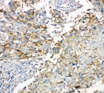 Cx43 Antibody Human Lung Cancer IHC. Immunohistochemical staining of FFPE human lung cancer tissue with Cx43 antibody. Cx43 immunoreactivity is observed predominantly along the membranes of malignant epithelial cells, consistent with the expected localization of this gap junction protein that mediates direct intercellular communication through gap junction channels. Cell nuclei are counterstained with hematoxylin (blue).
