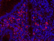 Myeloperoxidase Antibody Appendicitis IF. Immunofluorescent staining of FFPE human appendicitis tissue with Myeloperoxidase antibody (red) and DAPI nuclear stain (blue). HIER: steam section in pH8 EDTA buffer for 20 min.