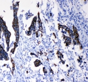 Cytokeratin 8 Antibody Intestinal Cancer IHC. Immunohistochemical staining of FFPE human intestinal cancer tissue using Cytokeratin 8 Antibody demonstrates strong membranous and cytoplasmic HRP-DAB brown staining within malignant epithelial cells, while surrounding stromal elements remain largely negative. The staining pattern is consistent with expression of Cytokeratin 8 (KRT8), a type II intermediate filament protein widely expressed in simple epithelial tissues and many epithelial-derived carcinomas. Cytokeratin 8 immunoreactivity highlights tumor-associated epithelial structures and supports identification of epithelial differentiation within intestinal cancer specimens. HIER: boil tissue sections in pH 8 EDTA for 20 minutes and allow to cool before testing.