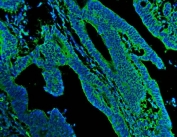 Immunofluorescent staining of FFPE human colon cancer tissue with N-Cadherin antibody (green) and DAPI nuclear stain (blue). HIER: steam section in pH8 EDTA for 20 min.