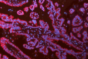 Immunofluorescent staining of FFPE human lung cancer tissue with N-Cadherin antibody (red) and DAPI nuclear stain (blue). HIER: steam section in pH8 EDTA for 20 min.