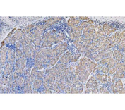 IHC staining of FFPE human liver cancer tissue with N-Cadherin antibody. HIER: boil tissue sections in pH8 EDTA for 20 min and allow to cool before testing.