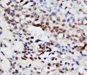 ERK1 Antibody IHC. Immunohistochemistry staining of ERK1 antibody with human breast cancer tissue.
