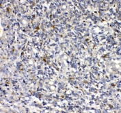 uPAR Antibody Human Glioma IHC. Immunohistochemical staining of FFPE human glioma tissue using uPAR Antibody. HIER was performed in pH 8.0 EDTA buffer. An HRP-conjugated secondary antibody with DAB substrate was used for detection. uPAR Antibody, recognizing PLAUR/uPA Receptor, demonstrates cytoplasmic and membranous staining in glioma cells, consistent with the role of uPAR as a cell invasion receptor involved in tumor cell migration, extracellular matrix remodeling, and cancer progression.