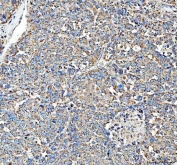 HSD11B1 Antibody Liver Immunohistochemistry. IHC staining of FFPE human liver cancer tissue with HSD11B1 antibody. HIER: boil tissue sections in pH8 EDTA for 20 min and allow to cool before testing.
