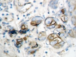 IHC-P: IP10 antibody testing of human breast cancer tissue