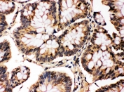 IHC testing of FFPE human intestinal cancer with MAPK8/9 antibody. HIER: boil tissue sections in pH6, 10mM citrate buffer, for 10-20 min followed by cooling at RT for 20 min.