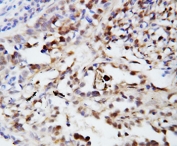 IHC-P: Ubiquitin antibody testing of human lung cancer tissue