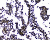 Galectin Antibody Human Glioma IHC. Immunohistochemical staining of FFPE human glioma tissue using Galectin antibody demonstrates strong membranous and cytoplasmic HRP-DAB brown staining within neoplastic cells and tumor-associated cellular structures. The staining pattern is consistent with expression of Galectin-1 (LGALS1), a beta-galactoside-binding lectin implicated in cell adhesion, immune modulation, extracellular matrix interactions, angiogenesis, and tumor progression. Robust Galectin-1 immunoreactivity within the glioma microenvironment supports the established association of LGALS1 with malignant behavior and tumor-stromal communication in central nervous system cancers. HIER: boil tissue sections in pH8 EDTA for 20 min and allow to cool before testing.