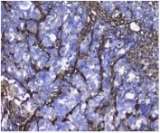 Galectin Antibody Human Stomach Cancer IHC. Immunohistochemical staining of FFPE human stomach cancer tissue using Galectin antibody demonstrates strong membranous and cytoplasmic HRP-DAB brown staining within malignant epithelial cells and tumor-associated cellular structures. The observed staining pattern is consistent with expression of Galectin-1 (LGALS1), a beta-galactoside-binding lectin involved in cell adhesion, immune regulation, extracellular matrix remodeling, angiogenesis, and tumor progression. Prominent Galectin-1 immunoreactivity within the gastric tumor microenvironment supports its recognized role in tumor-stromal interactions, metastatic potential, and glycan-mediated signaling pathways associated with cancer development. HIER: boil tissue sections in pH8 EDTA for 20 min and allow to cool before testing.