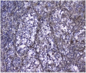 Galectin Antibody Human Liver Cancer IHC. Immunohistochemical staining of FFPE human liver cancer tissue using Galectin antibody demonstrates moderate to strong cytoplasmic and membranous HRP-DAB brown staining throughout malignant tumor cell populations. The observed staining pattern is consistent with expression of Galectin-1 (LGALS1), a beta-galactoside-binding lectin involved in immune regulation, cell adhesion, extracellular matrix remodeling, angiogenesis, and tumor progression. Widespread Galectin-1 immunoreactivity within the neoplastic tissue supports its established role in tumor microenvironment signaling and hepatocellular malignancy biology. HIER: boil tissue sections in pH8 EDTA for 20 min and allow to cool before testing.