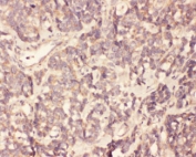 IHC testing of FFPE human gallbladder cancer tissue with FGF19 antibody at 1ug/ml. HIER: steam section in pH6 citrate buffer for 20 min.