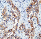 IHC staining of FFPE human bladder cancer tissue with AQP3 antibody. HIER: boil tissue sections in pH8 EDTA for 20 min and allow to cool before testing.