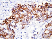 GCLC Antibody Rectal Cancer IHC. Immunohistochemistry testing of GCLC antibody with FFPE human rectal cancer tissue.