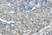 Desmoglein 2 Antibody Breast Cancer IHC. Immunohistochemistry analysis of FFPE human breast cancer tissue stained with Desmoglein 2 antibody detecting DSG2. Tumor epithelial cells demonstrate membranous and cytoplasmic staining with clear accentuation at cell-cell junctions, consistent with localization of DSG2 within desmosomal adhesion complexes that maintain epithelial structural integrity. Adjacent stromal elements show minimal staining. Hematoxylin counterstain highlights nuclei in blue. HIER: boil tissue sections in pH 8 EDTA buffer for 20 min and allow to cool before testing.
