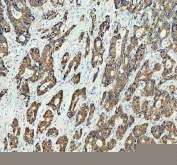 Immunohistochemical staining of FFPE human stomach cancer tissue with GRB7 antibody, HRP-secondary and DAB substrate. HIER: boil tissue sections in pH8 EDTA for 20 min and allow to cool before testing.