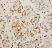 HOXA3 Antibody Human Pancreatic Cancer IHC. IHC staining of FFPE human pancreatic cancer tissue with HOXA3 antibody demonstrated predominantly nuclear staining in malignant epithelial cells, consistent with the localization of HOXA3 as a homeobox transcription factor that regulates developmental gene expression and cellular differentiation. HOXA3 plays essential roles in embryonic patterning, tissue specification, angiogenesis, and stem cell function, while dysregulated expression has been associated with multiple human malignancies, including pancreatic cancer. The observed nuclear staining supports the transcriptional regulatory function of HOXA3 and its involvement in tumor progression and tissue remodeling. HIER was performed by steaming tissue sections in pH 6 citrate buffer for 20 minutes followed by cooling prior to staining. These results support the utility of HOXA3 Antibody for studies of developmental biology, transcriptional regulation, angiogenesis, and cancer research.