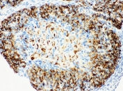 HSD17B1 Antibody Rat Ovary IHC. Immunohistochemistry staining of FFPE rat ovary tissue using HSD17B1 Antibody demonstrates strong cytoplasmic HRP-DAB brown staining within ovarian follicular and steroidogenic cell populations surrounding developing follicles. The staining pattern is consistent with expression of Hydroxysteroid 17-Beta Dehydrogenase 1 (HSD17B1), a key enzyme involved in estrogen biosynthesis that catalyzes the conversion of estrone to biologically active estradiol. Prominent ovarian staining is consistent with the established role of HSD17B1 in steroid hormone metabolism, reproductive physiology, follicular development, and endocrine regulation. Required HIER: steam tissue sections in pH 6 citrate buffer for 20 minutes before testing.