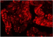 Ku80 Antibody Intestine Cancer IF. Immunofluorescence analysis of formalin-fixed, paraffin-embedded human intestinal cancer tissue using Ku80 antibody. The antibody signal (red) shows prominent nuclear staining within tumor epithelial cells, consistent with activation of DNA damage response pathways involving Ku80 (XRCC5). Signal intensity is enriched in densely cellular tumor regions, reflecting engagement of DNA repair and stress signaling mechanisms. The staining pattern supports the role of Ku80 as a nuclear mediator of DNA damage response in cancer tissue.