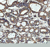 Immunohistochemistry analysis of MYD88 expression in human colon cancer tissue. Paraffin-embedded human colon cancer sections were subjected to heat-mediated antigen retrieval in EDTA buffer (pH 8.0) and incubated with anti-MYD88 antibody, followed by HRP-conjugated secondary antibody and DAB chromogen development. MYD88 staining is observed mainly in tumor-associated epithelial cells and infiltrating immune cells, consistent with cytoplasmic adaptor protein localization, with hematoxylin nuclear counterstain (blue).