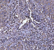 NLRP3 Antibody Cervical Carcinoma IHC. Immunohistochemistry analysis of FFPE human squamous cell cervical carcinoma tissue stained with NLRP3 Antibody. Cytoplasmic HRP-DAB brown staining is observed throughout tumor epithelial cell populations and adjacent inflammatory-associated cellular elements, consistent with the expected expression pattern of NLRP3 / Cryopyrin, an inflammasome-associated signaling protein involved in innate immune activation, inflammatory regulation, and pyroptosis-associated cellular pathways. Tissue sections underwent HIER using pH 8 EDTA buffer prior to immunostaining.