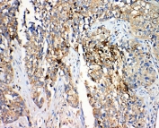 IHC-P: 17-beta-Hydroxysteroid dehydrogenase 4 antibody testing of human lung cancer tissue. Required HIER: steam section in pH6 citrate buffer for 20 min.