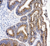 IHC-P: 17-beta-Hydroxysteroid dehydrogenase 4 antibody testing of human intestinal cancer tissue. Required HIER: steam section in pH6 citrate buffer for 20 min.