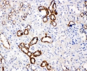 GLUT5 Antibody Rat Kidney IHC. Immunohistochemical staining of rat kidney demonstrates GLUT5 expression using a GLUT5 antibody. GLUT5, also known as Fructose Transporter Protein, is a facilitative transporter responsible for fructose uptake and plays an important role in carbohydrate metabolism and nutrient homeostasis. Strong membranous staining is observed in renal tubular epithelial cells, consistent with the known localization of GLUT5 in kidney tissues involved in fructose reabsorption and transport. Heat induced epitope retrieval and immunoperoxidase staining reveal robust expression of this fructose transporter in rat kidney. These results support the utility of GLUT5 Antibody for studies of fructose metabolism, renal physiology, and metabolic regulation.