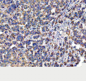 IHC analysis of DCI Antibody / Dodecenoyl-CoA delta isomerase (ECI1). ECI1 expression was examined in a paraffin-embedded section of human liver cancer tissue. Following heat-mediated antigen retrieval in EDTA buffer (pH 8.0), tissue sections were blocked with goat serum and incubated with a rabbit anti-ECI1 antibody. Immunoreactivity was visualized using an HRP-based detection system with DAB chromogen. Strong cytoplasmic staining is observed in tumor cells, consistent with the expected mitochondrial localization of ECI1 in metabolically active hepatic tissue.