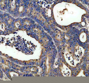 IHC analysis of DCI Antibody / Dodecenoyl-CoA delta isomerase (ECI1). ECI1 expression was examined in a paraffin-embedded section of human colon cancer tissue. Following heat-mediated antigen retrieval in EDTA buffer (pH 8.0), tissue sections were blocked with goat serum and incubated with a rabbit anti-ECI1 antibody. Immunoreactivity was visualized using an HRP-based detection system with DAB chromogen. Cytoplasmic staining is observed in tumor epithelial cells, consistent with the mitochondrial localization of ECI1, while surrounding stromal areas show lower background signal.