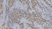 Aryl Hydrocarbon Receptor Antibody Gastric Cancer IHC. Immunohistochemical staining of FFPE human gastric cancer tissue demonstrates AHR expression using an Aryl Hydrocarbon Receptor antibody. AHR, also known as an Environmental Sensor Protein, is a ligand activated transcription factor that integrates signals from xenobiotics, dietary metabolites, and inflammatory pathways to regulate gene expression and cellular homeostasis. Predominantly nuclear and cytoplasmic staining is observed throughout malignant cells, consistent with active AHR signaling and its emerging role in tumor progression and metabolic adaptation. Heat induced epitope retrieval was performed by boiling tissue sections in pH 8 EDTA buffer for 20 minutes followed by cooling prior to staining. These findings support the utility of AHR Antibody for studies of cancer biology, toxicology, and transcriptional regulation.