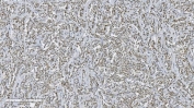 Aryl Hydrocarbon Receptor Antibody Lymphadenoma IHC. Immunohistochemical staining of FFPE human lymphadenoma tissue demonstrates AHR expression using an Aryl Hydrocarbon Receptor antibody. AHR, also known as an Environmental Sensor Protein, is a ligand activated transcription factor that regulates immune cell differentiation, inflammatory signaling, and cellular responses to endogenous and environmental ligands. Diffuse nuclear and cytoplasmic staining is observed throughout the lymphoid tumor cells, consistent with the established role of AHR in modulating immune homeostasis and hematopoietic cell function. Heat induced epitope retrieval was performed by boiling tissue sections in pH 8 EDTA buffer for 20 minutes followed by cooling prior to staining. These results support the utility of AHR Antibody for studies of immunology, lymphoid malignancies, and signal transduction pathways.