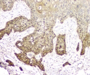 IHC staining of FFPE human esophagus squama cancer with 14-3-3 sigma antibody. HIER: boil tissue sections in pH8 EDTA for 20 min and allow to cool before testing.