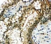 IHC-P: HSP70 antibody testing of human intestinal cancer tissue.