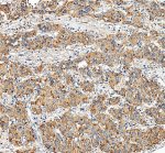 LAMP1 Antibody Human Liver Cancer IHC. Immunohistochemical staining of FFPE human liver cancer tissue using LAMP1 Antibody / Lysosomal Membrane Glycoprotein Antibody following heat-induced epitope retrieval in pH8 EDTA buffer. The antibody was applied at 2 ug/ml and detected using an HRP-conjugated secondary antibody with DAB chromogen. Strong granular cytoplasmic staining is observed throughout the malignant hepatocytes, consistent with abundant lysosomal localization, while the surrounding stromal tissue exhibits comparatively weaker immunoreactivity. This LAMP1 Antibody is suitable for investigating lysosomal membrane biology, intracellular trafficking, autophagy, and liver cancer progression.