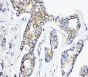 CD1D Antibody for IHC immunohistochemistry analysis of CD1d antigen in human breast cancer tissue. Formalin-fixed paraffin-embedded human breast cancer tissue stained with CD1d antibody shows HRP-DAB brown chromogenic signal primarily localized to the cell membrane and cytoplasm of tumor epithelial cells forming malignant glandular structures. The staining pattern outlines the cell membranes of tumor cells with variable cytoplasmic signal, while surrounding stromal cells display minimal staining. Heat induced epitope retrieval was performed by steaming tissue sections in pH 6 citrate buffer for 20 minutes prior to antibody incubation.