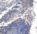 CSF1R Antibody IHC in Human Breast Cancer. Immunohistochemistry of FFPE human breast cancer tissue was performed with CSF1R Antibody at 2 ug/ml following heat-induced epitope retrieval in pH 8 EDTA buffer. Scattered cells show distinct brown cytoplasmic and membranous staining among largely negative tumor and stromal cell populations. The restricted staining pattern supports detection with an M-CSF Receptor Antibody in human breast cancer tissue.