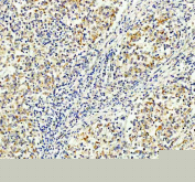 Immunohistochemical staining of FFPE human lymphoma tissue with MALT1 antibody, HRP-secondary and DAB substrate. HIER: boil tissue sections in pH8 EDTA for 20 min and allow to cool before testing.