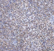 IHC staining of FFPE human intestinal diffuse large B-cell lymphoma tissue with TFAM antibody. HIER: boil tissue sections in pH8 EDTA for 20 min and allow to cool before testing.