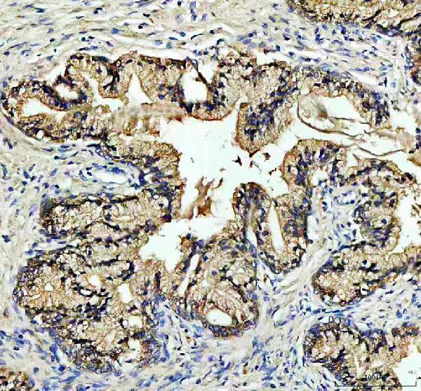 NOX5 Antibody Human Prostate Cancer IHC. Immunohistochemical staining of FFPE human prostate cancer tissue with NOX5 / NADPH Oxidase 5 antibody at 2 ug/ml. Heat-induced epitope retrieval (HIER) was performed using pH 8 EDTA buffer prior to staining. Strong NOX5 immunoreactivity is observed predominantly within the cytoplasm and along the cell membranes of malignant prostatic epithelial cells, while the surrounding stromal tissue shows comparatively weak staining. Cell nuclei are counterstained with hematoxylin (blue).