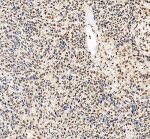 DNA-PKcs Antibody Human Ovarian Cancer IHC. Immunohistochemical staining of FFPE human ovarian cancer tissue using DNA-PKcs antibody. Heat-induced epitope retrieval was performed in pH 8.0 EDTA buffer before incubation with DNA-PKcs antibody at 2 ug/ml. An HRP-conjugated secondary antibody with DAB chromogen was used for visualization. Tumor cells display strong nuclear staining with weaker cytoplasmic staining, consistent with the established role of DNA-PKcs in nuclear DNA damage repair and genome maintenance. This DNA-PKcs Antibody, also called PRKDC Antibody, is suitable for studies of DNA damage repair, non-homologous end joining, genome stability, and DNA repair signaling.
