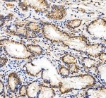 DNA-PKcs Antibody Human Gastric Carcinoma IHC. Immunohistochemical staining of FFPE human gastric carcinoma tissue using DNA-PKcs antibody. Heat-induced epitope retrieval was performed in pH 8.0 EDTA buffer before incubation with DNA-PKcs antibody at 2 ug/ml. An HRP-conjugated secondary antibody with DAB chromogen was used for visualization. Tumor cells show predominantly nuclear staining with weaker cytoplasmic staining, consistent with the known localization and function of DNA-PKcs in DNA damage repair. This DNA-PKcs Antibody, also called PRKDC Antibody, is suitable for studies of DNA damage repair, non-homologous end joining, genome stability, and DNA repair signaling.