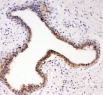IHC-P: TrkC antibody testing of human breast cancer tissue