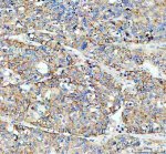 Flotillin 1 Antibody Human Liver Cancer IHC High Magnification. IHC staining of FFPE human liver cancer tissue with Flotillin 1 Antibody at 2 ug/ml. HIER was performed using pH 8 EDTA buffer, followed by blocking with 10% goat serum. The tissue section was incubated with rabbit anti-FLOT1 antibody overnight at 4Â°C, followed by HRP-conjugated goat anti-rabbit IgG secondary antibody and DAB chromogen detection. Flotillin 1 Antibody / Lipid Raft Marker Antibody demonstrates membrane and cytoplasmic staining consistent with FLOT1 expression and supports research into lipid raft organization, membrane-associated signaling and cancer cell biology pathways.