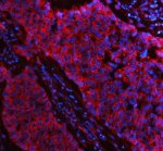Flotillin 1 Antibody Human Lung Cancer IF. Immunofluorescent staining of FFPE human non-small cell lung cancer tissue with Flotillin 1 Antibody at 5 ug/ml. HIER was performed using pH 8 EDTA buffer, followed by blocking with 10% goat serum. The tissue section was incubated with rabbit anti-FLOT1 antibody overnight at 4Â°C, followed by Cy3 conjugated goat anti-rabbit IgG secondary antibody (red). Nuclei were counterstained with DAPI (blue). Flotillin 1 Antibody / Lipid Raft Marker Antibody demonstrates membrane and cytoplasmic staining consistent with FLOT1 expression and supports studies of membrane microdomains, lipid raft biology and cancer cell signaling pathways.