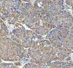 Flotillin 1 Antibody Human Liver Cancer IHC. IHC staining of FFPE human liver cancer tissue with Flotillin 1 Antibody at 2 ug/ml. HIER was performed using pH 8 EDTA buffer, followed by blocking with 10% goat serum. The tissue section was incubated with rabbit anti-FLOT1 antibody overnight at 4Â°C, followed by HRP-conjugated goat anti-rabbit IgG secondary antibody and DAB chromogen detection. Flotillin 1 Antibody / Lipid Raft Marker Antibody demonstrates membrane and cytoplasmic staining consistent with FLOT1 expression and supports studies of lipid raft organization, membrane microdomains, vesicle trafficking and cancer cell signaling pathways.
